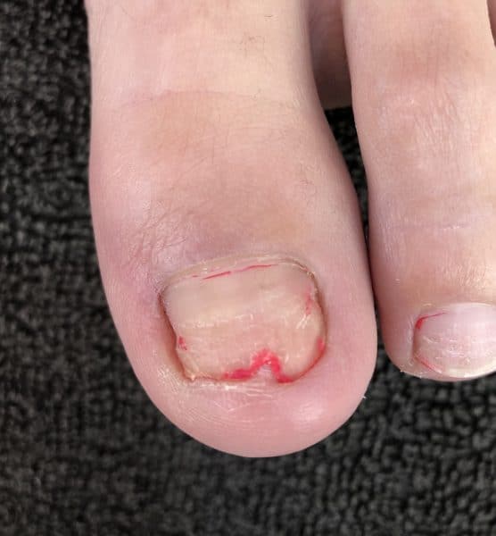 Broken toenail with half still attached : r/mildlyinteresting