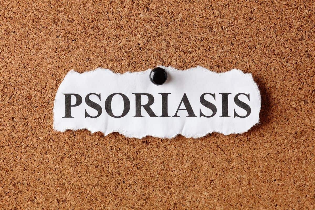 5 things you should know about treating clients with psoriasis at the nail salon